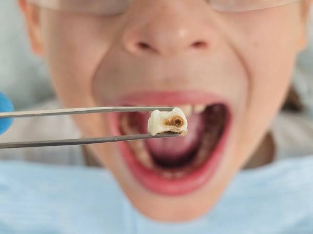 Best Dentist for Tooth Abscess  in Wickes, AR